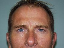 botulinum toxin After